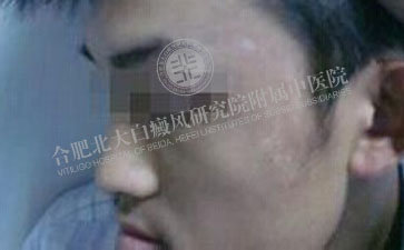 青少年白癜风，是不是跟压力有关